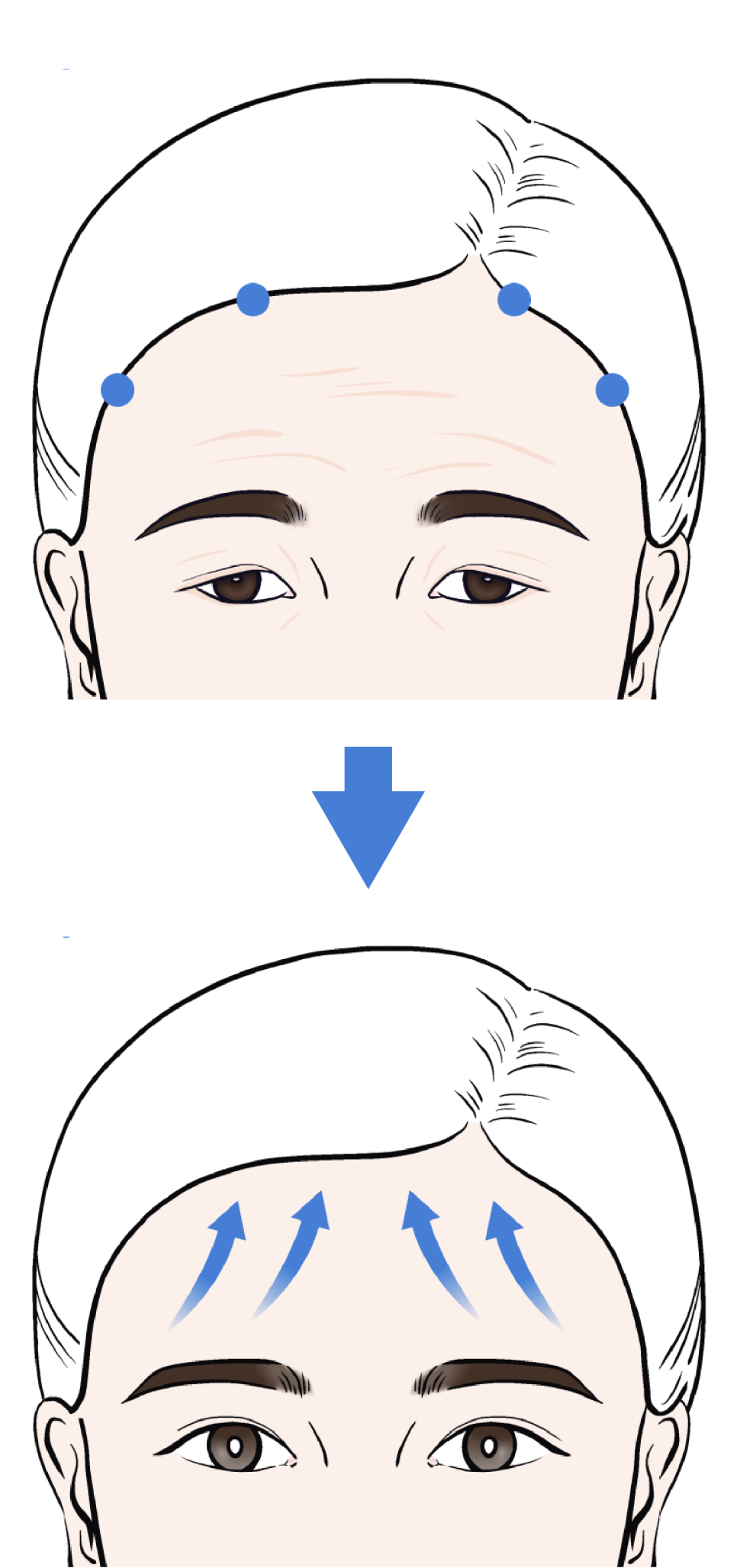 신사이마리프팅으로 달라지는 동안 한끗, 리프팅성형외과 전문의가 밝히는 결정적 차이 관련 이미지 4