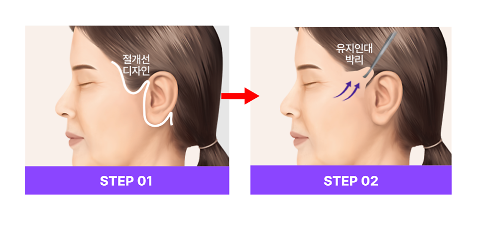강남역성형외과 스마일거상 볼륨까지 살리는 반거상 리프팅의 핵심은? 관련 이미지 9