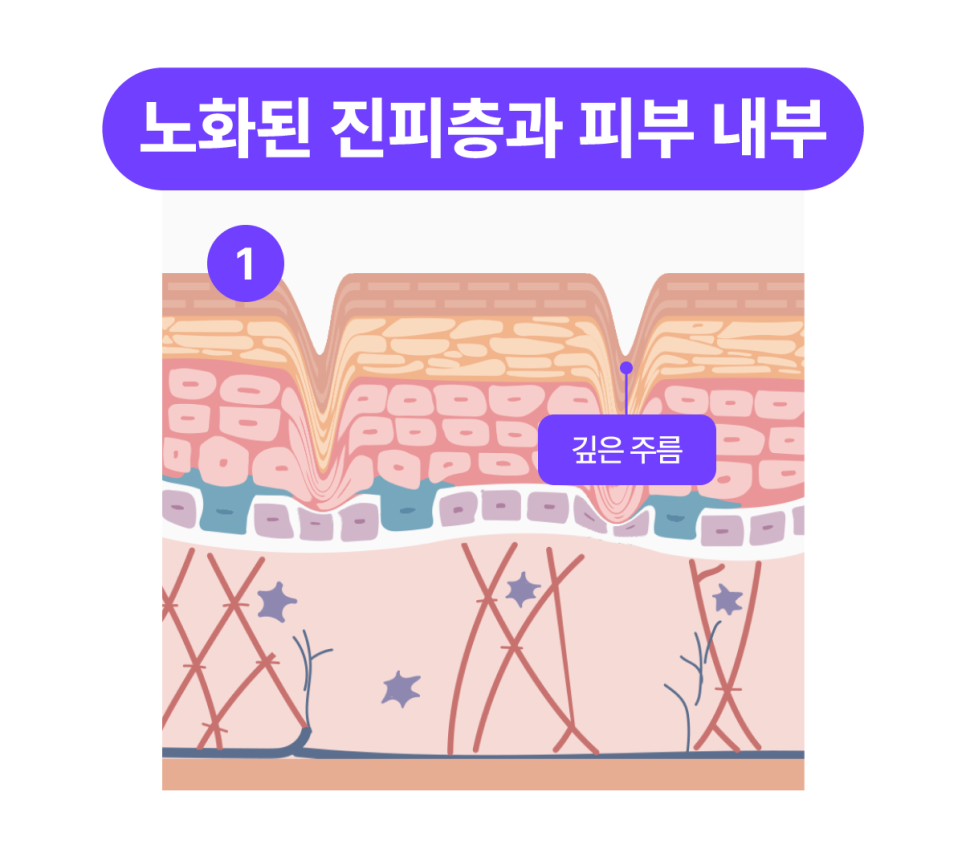 논현역성형외과 베네핏주사 수술 없이 피부 탄력 채우는 방법 관련 이미지 5