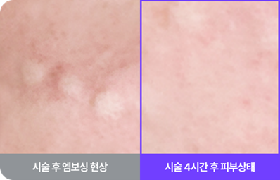 논현역성형외과 베네핏주사 수술 없이 피부 탄력 채우는 방법 관련 이미지 17