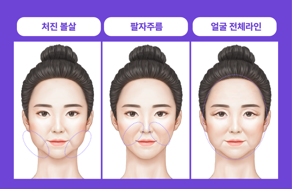 Shinsa Mini Lift, Lifting Plastic Surgery Clinic: Clear Answers to Frequently Asked Questions About Smile Lifting! image 5
