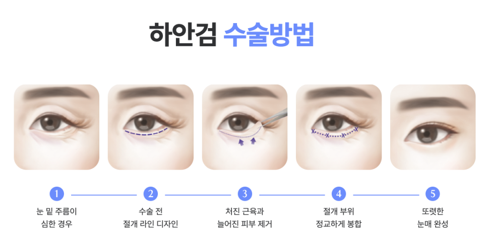 신사리프팅성형외과 눈밑지방재배치수술비용 궁금하다면? 하안검 수술과 비교해보세요 관련 이미지 7