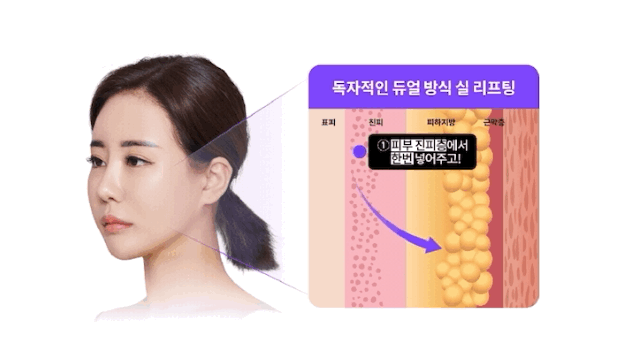 리팅성형외과 미니리프팅 궁금한 점 알려드립니다 관련 이미지 7