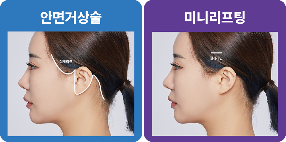 여름철 리팅의원 강남미니리프팅 많은 이들이 찾는 이유는? 관련 이미지 4