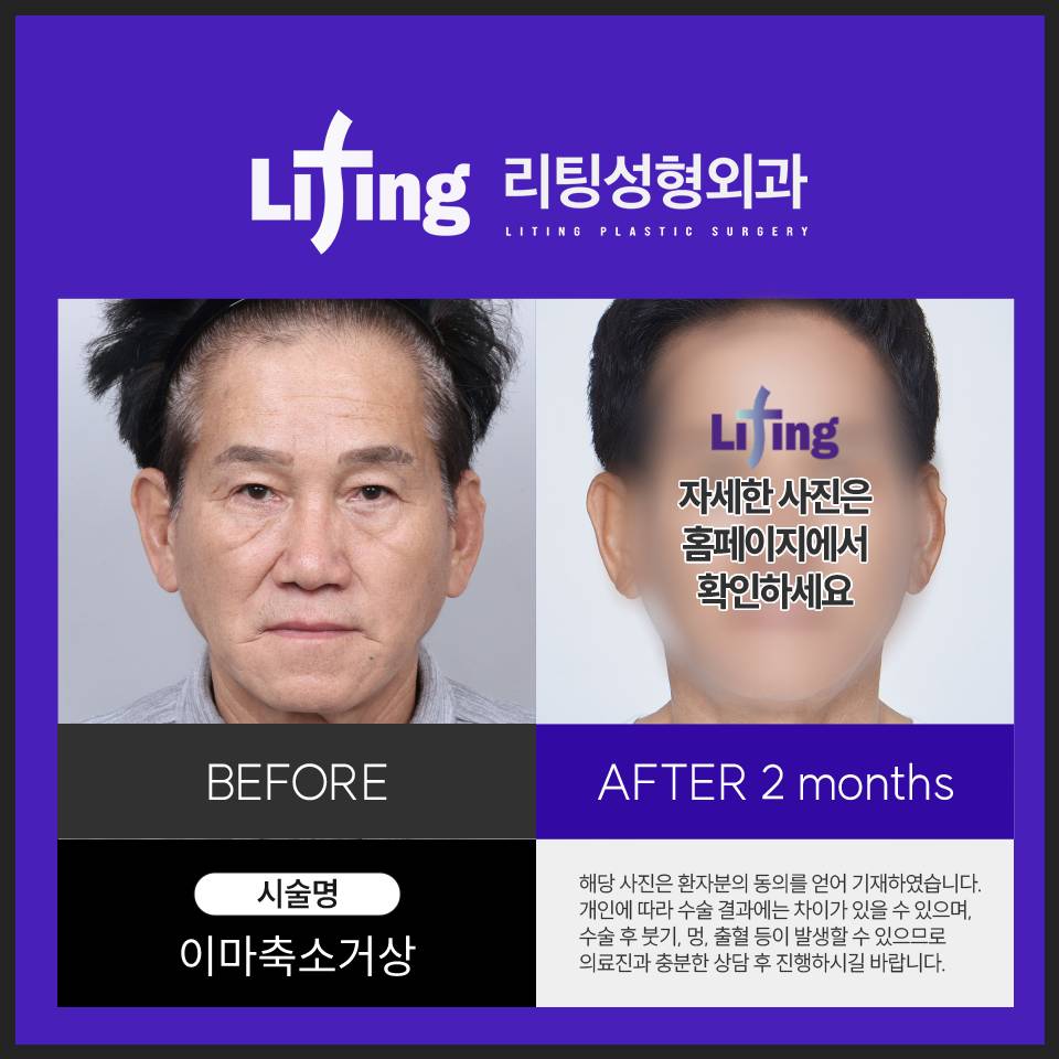 이마거상재수술? 고려하기 전에 핵심을 알아야 합니다 관련 이미지 6
