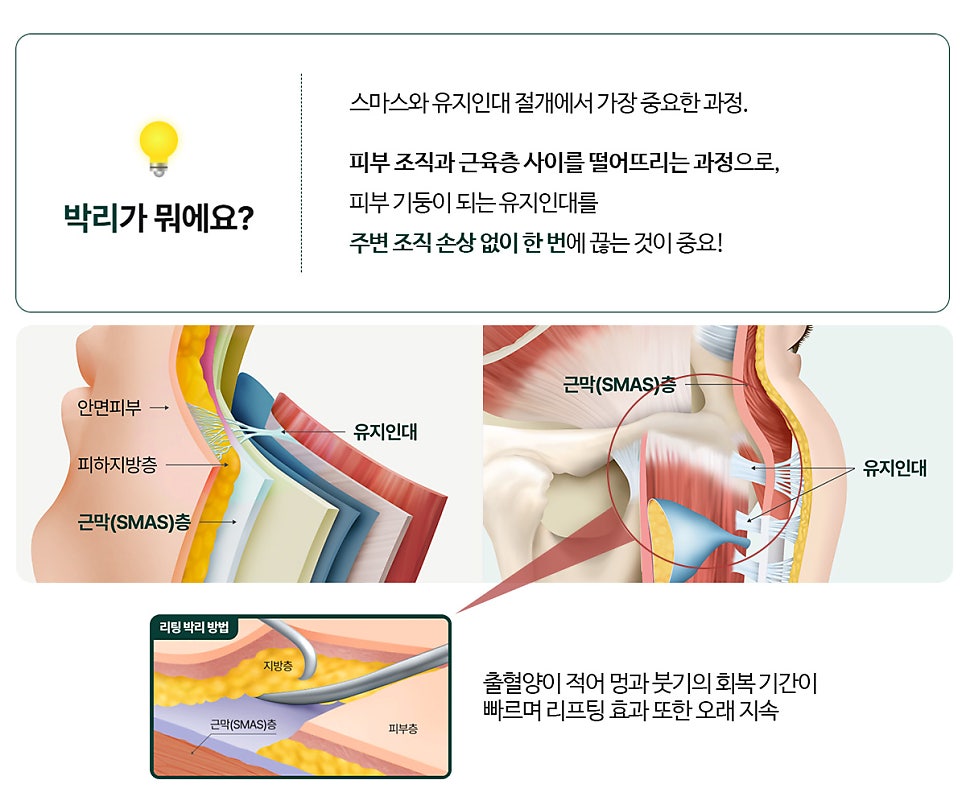 Considering a Facelift in Your 40s? Why Ligament Dissection Is Important at a Gangnam Lifting Clinic image 5