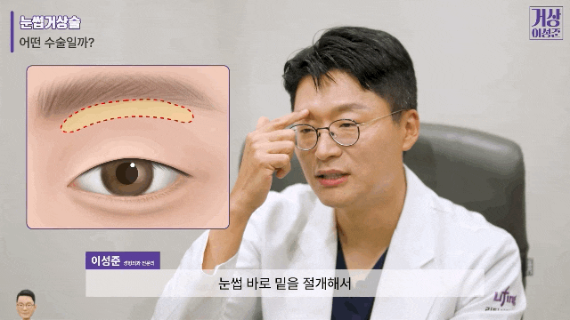 눈썹거상술 비용 가격 알고 싶다면 관련 이미지 4