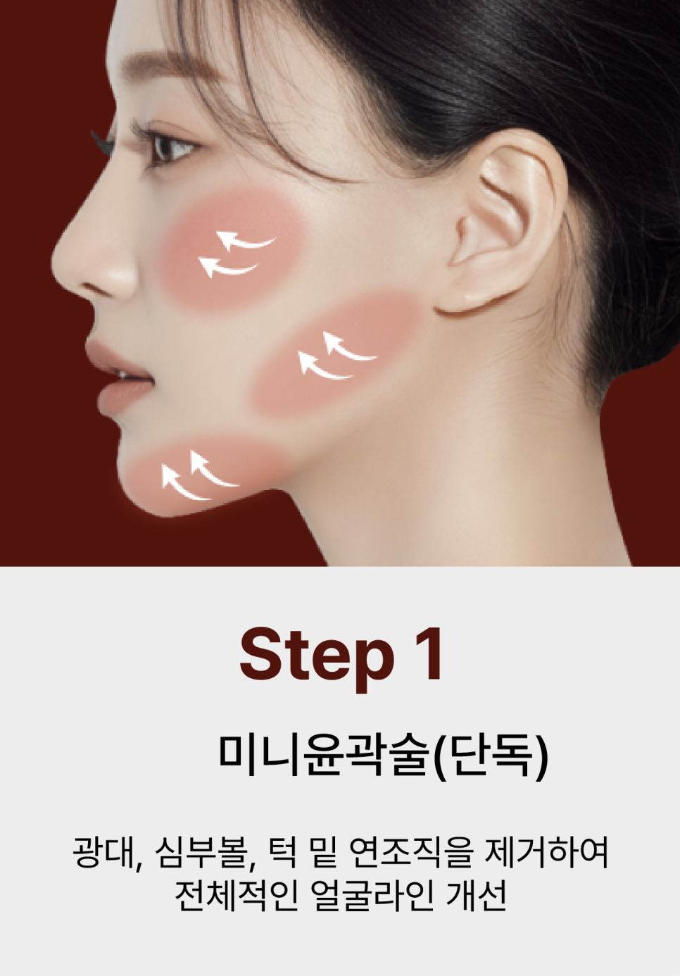 윤곽성형을 고민하게 되는 광대콤플렉스, 원인은 뼈만이 아닙니다 관련 이미지 12