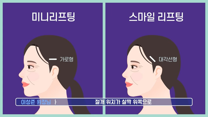 Sinsa Facial Rejuvenation, Gangnam Lifting Plastic Surgery Clinic: Natural Custom Trend Lifting image 9