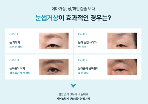 청담성형외과 눈꺼풀 처짐 고민, 안검하수비용이 궁금하다면? 관련 이미지 8
