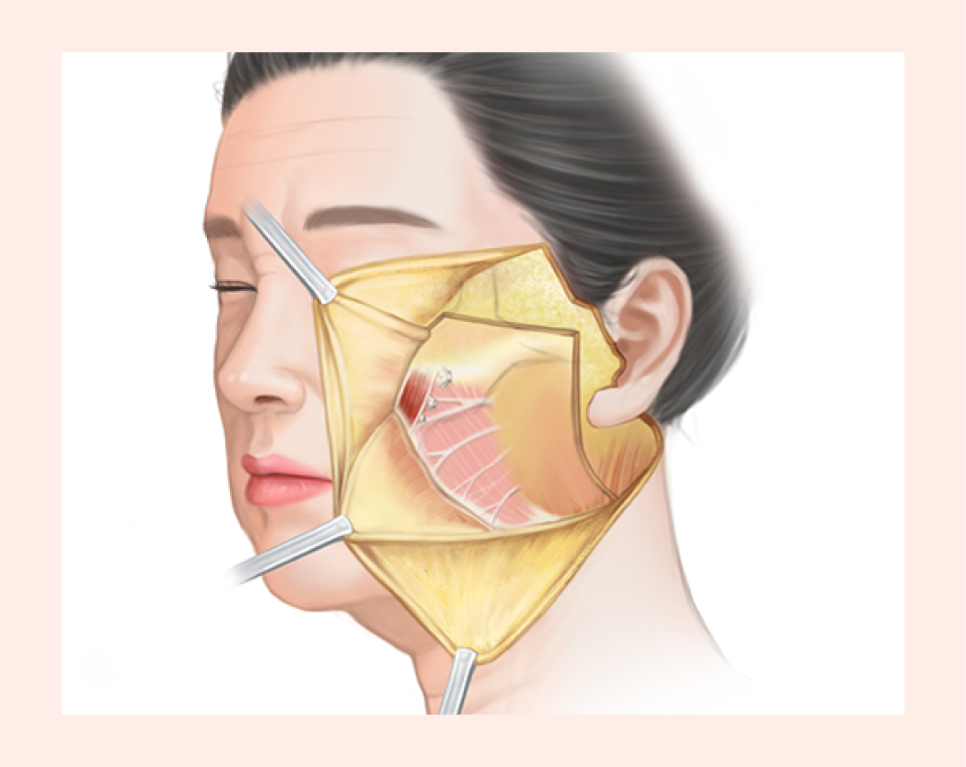 윤곽성형을 고민하게 되는 광대콤플렉스, 원인은 뼈만이 아닙니다 관련 이미지 10