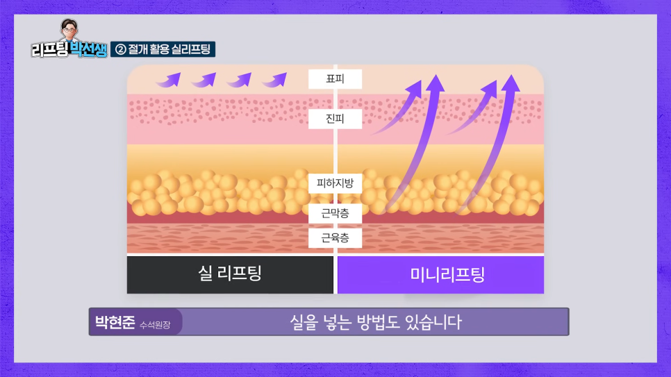 Changing Facial Contours Every Season? Finding Balance with the Mini Lifting Duration and the Approach of a Plastic Surgery Clinic in Nonhyeon-dong image 8