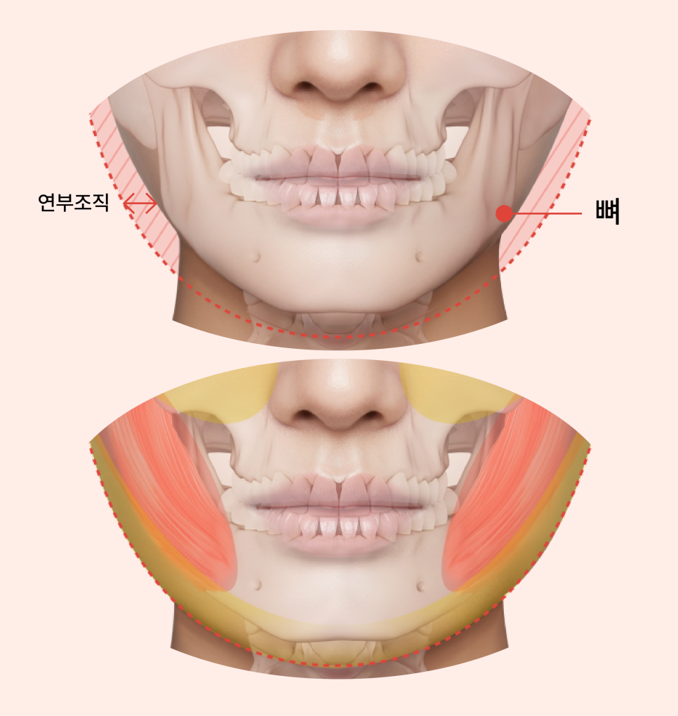 윤곽성형을 고민하게 되는 광대콤플렉스, 원인은 뼈만이 아닙니다 관련 이미지 5