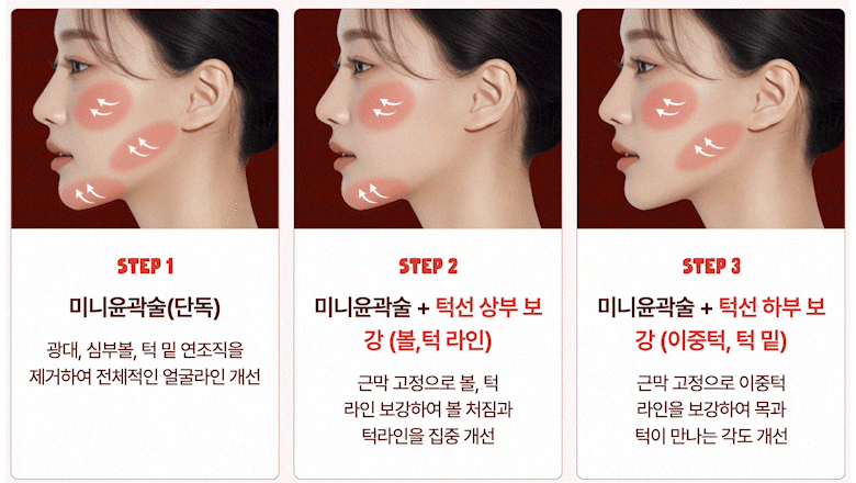 동안얼굴, 윤곽성형의 흐름이 바뀌다 | 미니윤곽술 서울점의 접근법 관련 이미지 13
