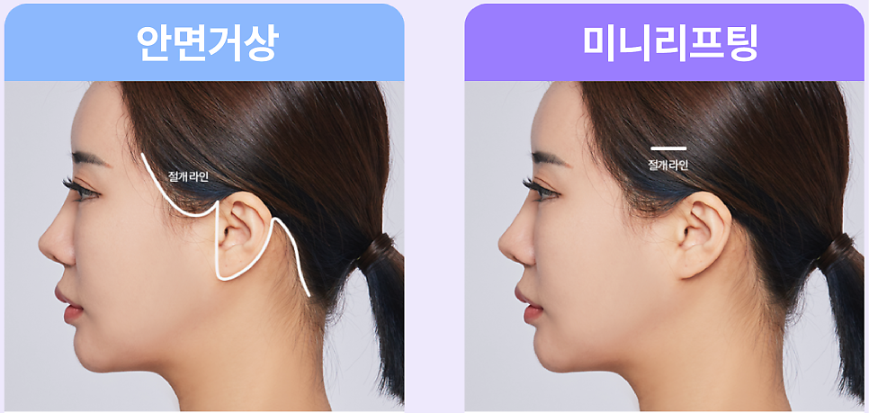 Gangnam Facelift vs. Sinsa Station Lifting: Why Is the Difference in Results So Big? image 6