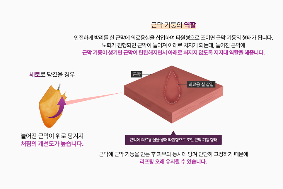 심부볼 마리오네트 확실한 주름개선, 강남성형외과 리팅 시그니처 리프팅? 관련 이미지 5