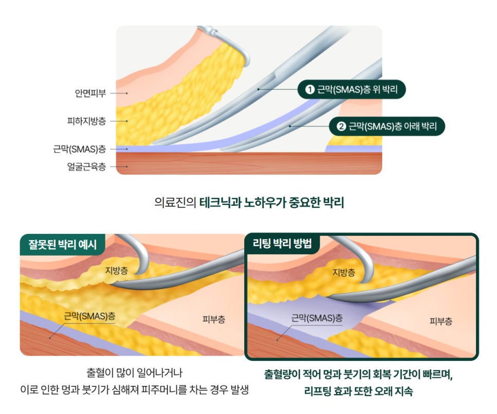 신사역성형외과 나이별로 가성비 좋은 리프팅, 실리프팅, 미니리프팅 관련 이미지 9