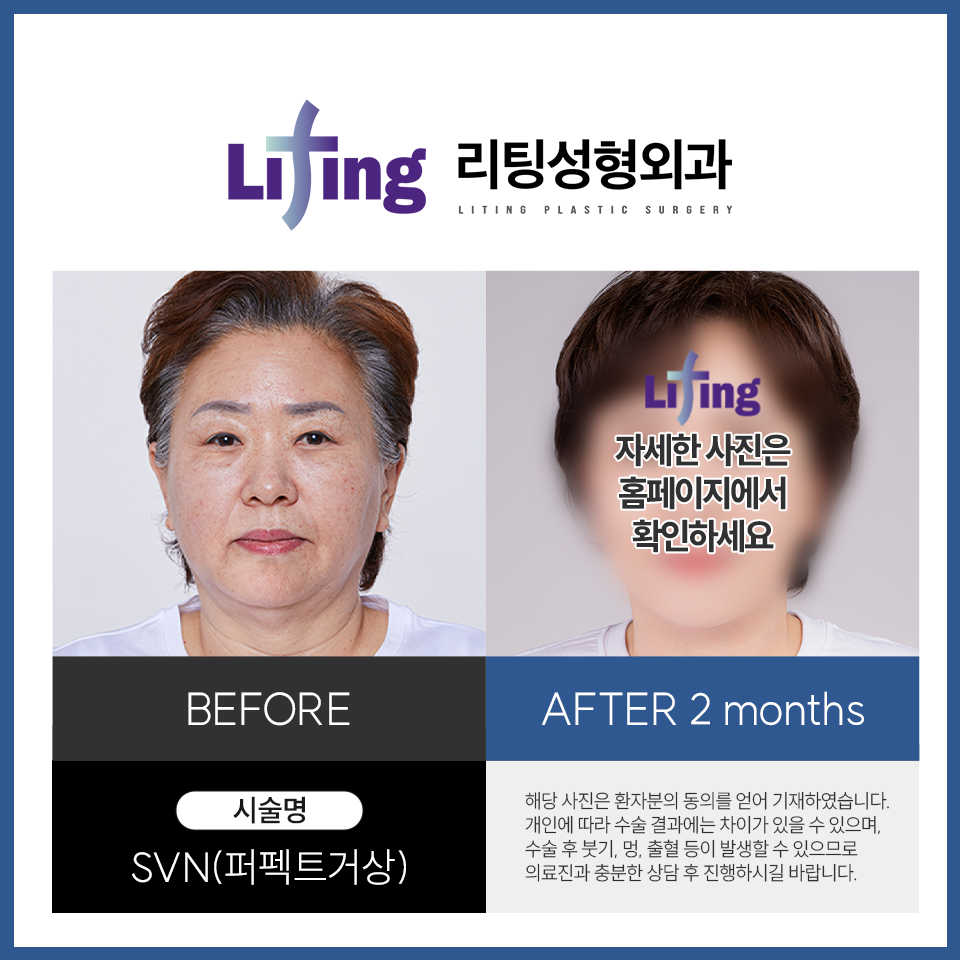 안면거상술잘하는병원? 어떤 점이 다른지 알려드리겠습니다 관련 이미지 4