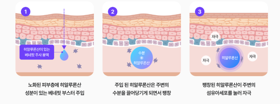 논현역성형외과 베네핏주사 수술 없이 피부 탄력 채우는 방법 관련 이미지 9