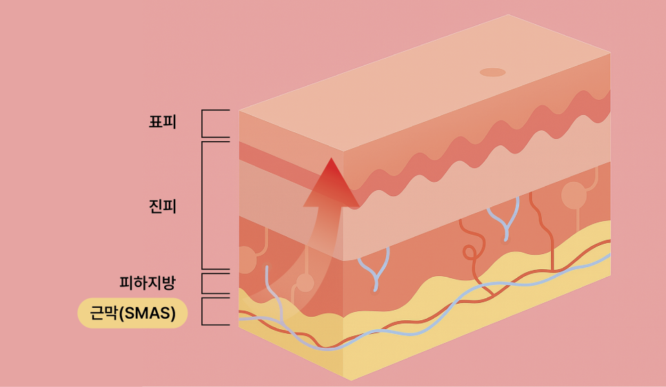 미니리프팅후기 신사역리프팅: 수술 원리와 선택 시 알아둬야 할 포인트 관련 이미지 4