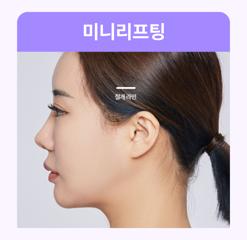 Smile Lifting Review and the Latest Lifting Trends Noted by Gangnam Lifting Dermatology Clinics image 5