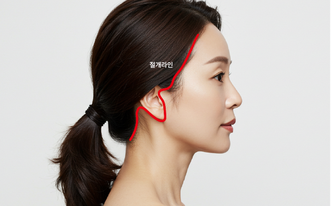 강남미니거상, 왜 안면거상성형외과에서도 주목할까? 관련 이미지 7