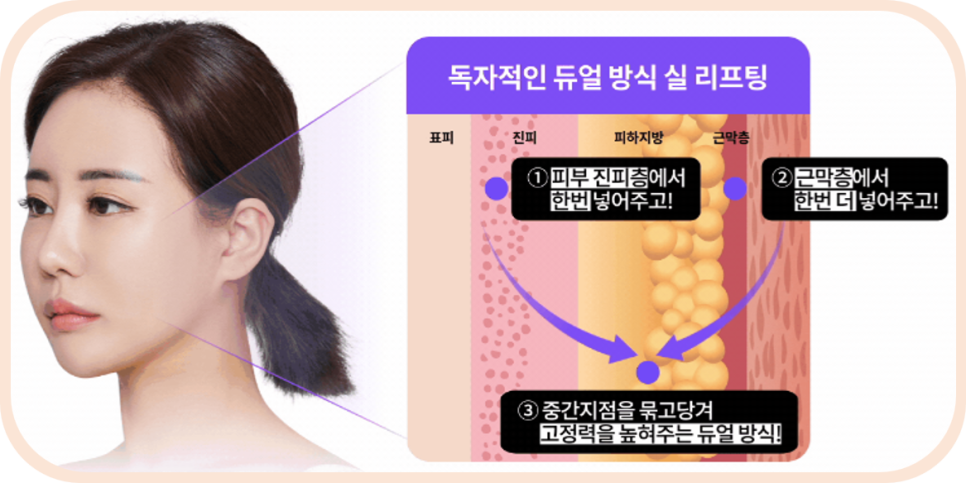 Facial Sagging Lift: Where to Start? Step-by-Step Elasticity Care Beginning with Apgujeong Thread Lifting image 18
