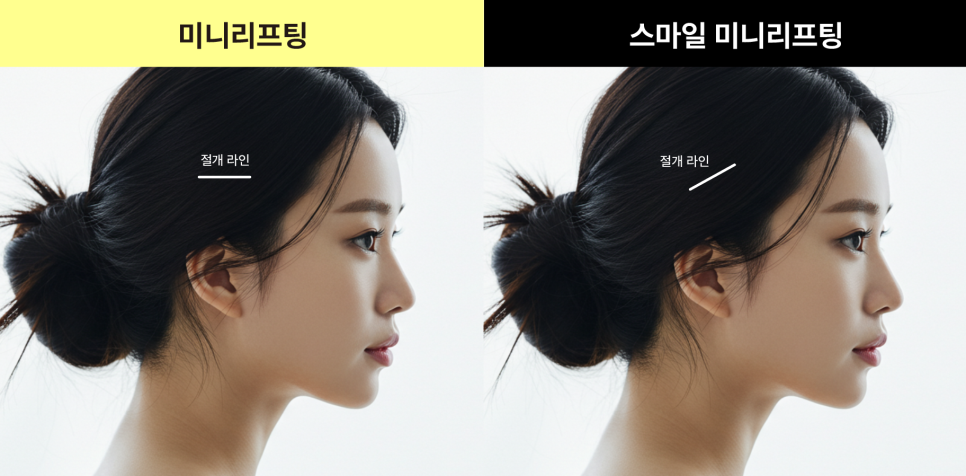 Changing Facial Contours Every Season? Finding Balance with the Mini Lifting Duration and the Approach of a Plastic Surgery Clinic in Nonhyeon-dong image 13