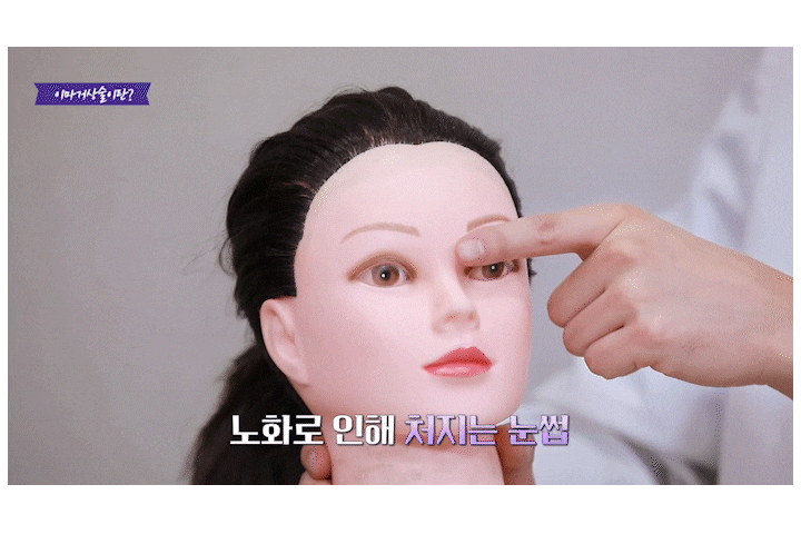Songpa Plastic Surgery Forehead Wrinkle Botox: The Real Reason It Didn’t Work for Me image 4