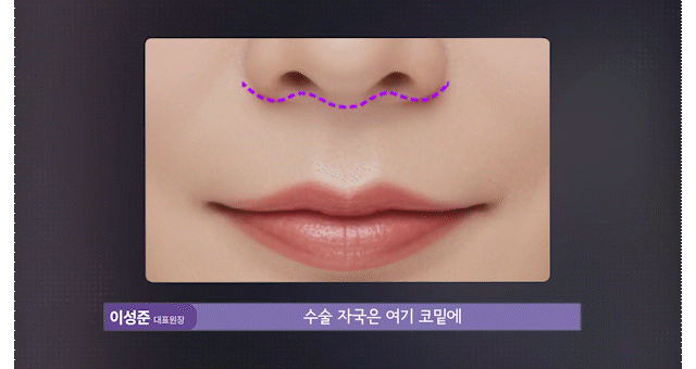 인중축소술로 보는 동안얼굴관리 &mdash; 비율 중심의 의학적 접근 관련 이미지 14