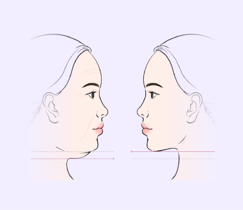The Secret to Improving the Face and Neckline at the Same Time, Explained Through V-Neck Lifting and Recommended by a Sinsa Station Plastic Surgery Clinic image 6