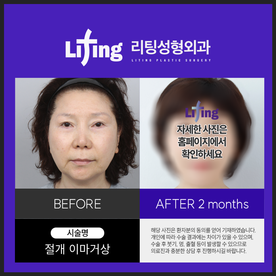 이마거상 전후로 알아보는 성공적인 결과를 얻기 위한 <포인트> 관련 이미지 6