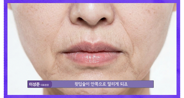인중축소술로 보는 동안얼굴관리 &mdash; 비율 중심의 의학적 접근 관련 이미지 5