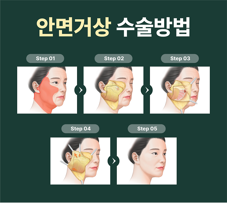 Subtle, Natural Beauty with Facial Wrinkle Lifting at Sinsa Station Leting Plastic Surgery image 15