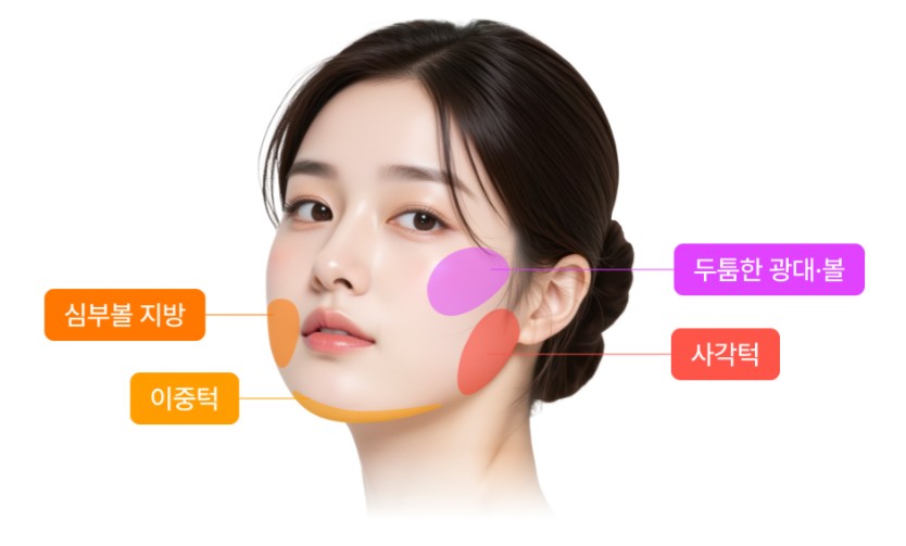 Sinsa Station Lifting Plastic Surgery Clinic Mini Contouring: How to Refine Facial Lines Without Bone Reduction | Liting Plastic Surgery Seoul Branch image 5