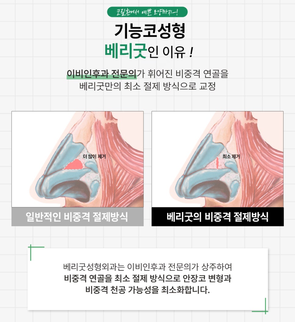 비염 수술과 코성형, 한 번에 가능할까? 기능코성형 전 알아야 할 점 관련 이미지 3