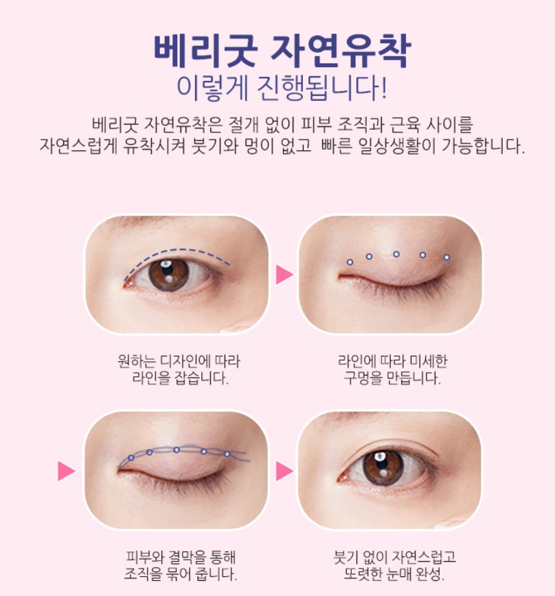 첫눈성형, 자연유착 이벤트 베리굿성형외과 관련 이미지 4