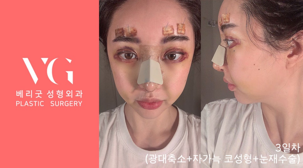 베리굿성형외과 (광대축소+눈재수술+자가늑 코) 리얼스토리💯 관련 이미지 2