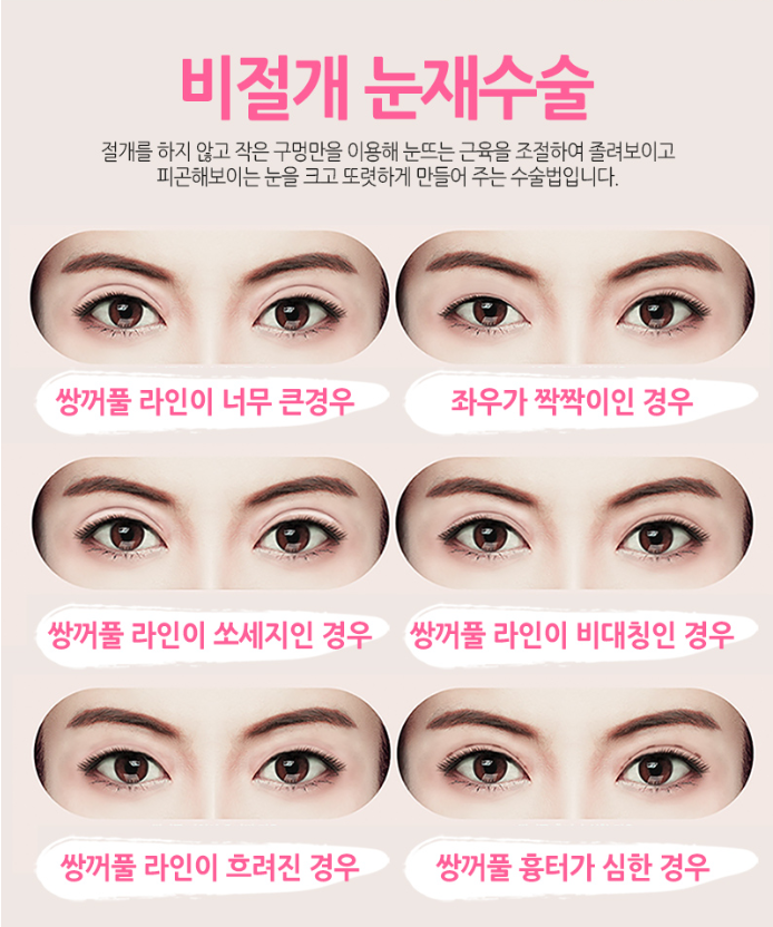 나의 마지막 눈성형 쌍꺼풀재수술! 어디에서 해야할까?? 관련 이미지 3