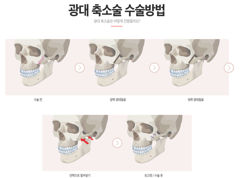 [베리굿성형외과]안면윤곽 리얼전후! 관련 이미지 5