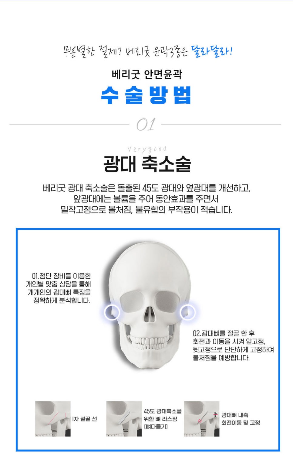 강남역광대축소 베리굿성형외과💜 관련 이미지 5