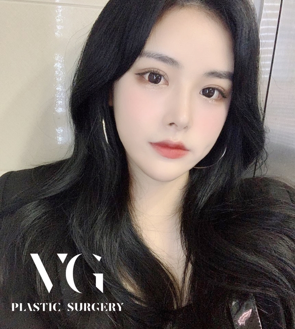 칙칙한 눈밑! 눈밑지방재배치로 환하고 생기있게! 관련 이미지 1