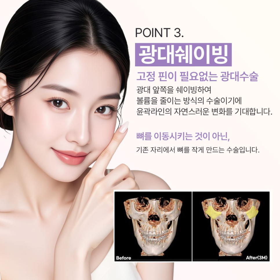 연예인 얼굴형 관리법 ? 요새 트렌드인 베리굿 성형외과 핀없는 안면윤곽 관련 이미지 5