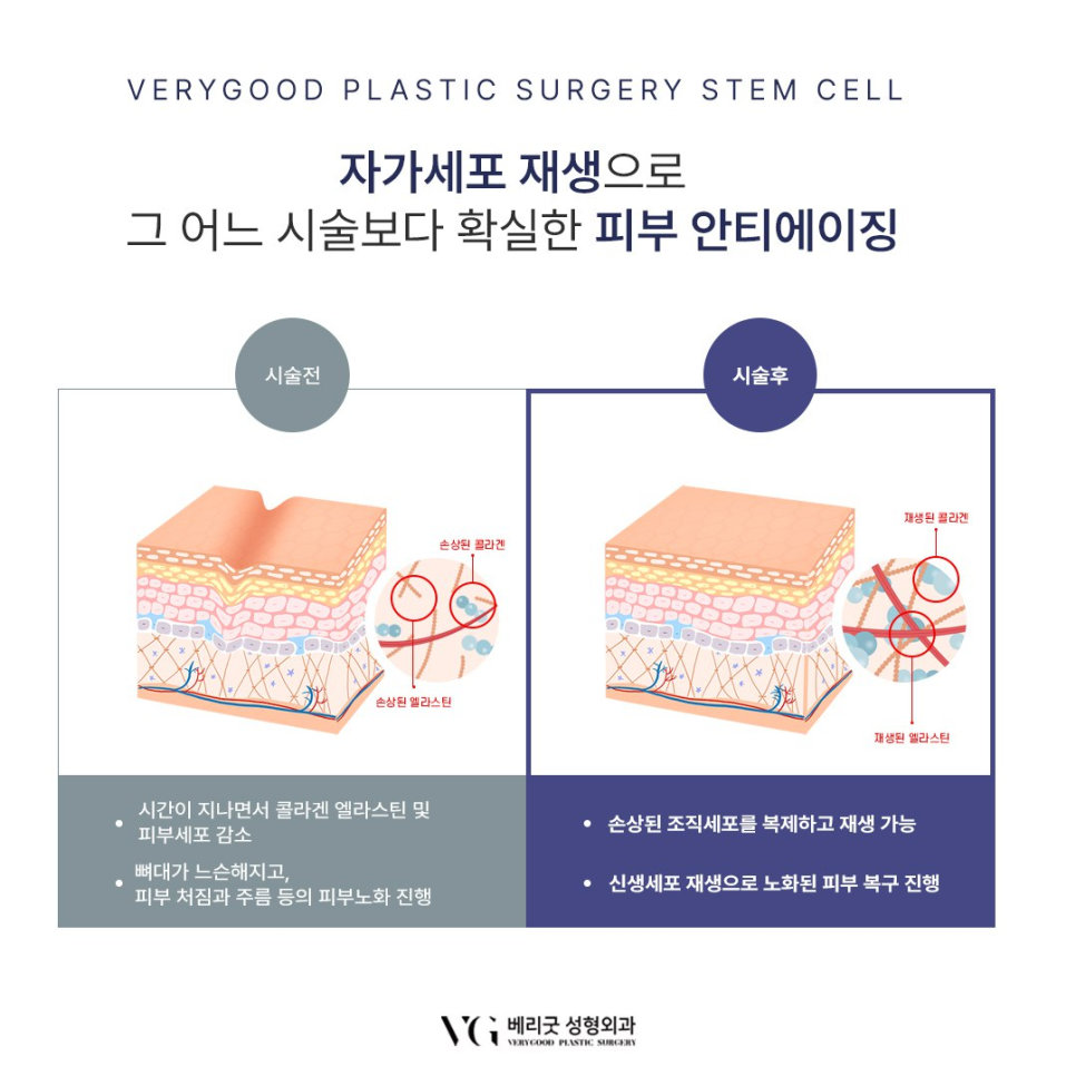 강남 베리굿성형외과 , 줄기세포 시술로 피부 안티에이징부터 탈모 치료효과까지 관련 이미지 8