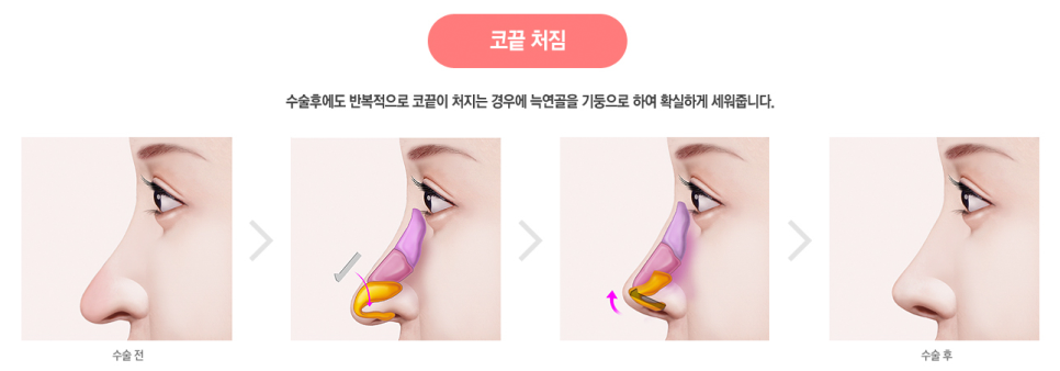 베리굿에서 자가늑연골로 베리굿하게 코수술하자💜 관련 이미지 6