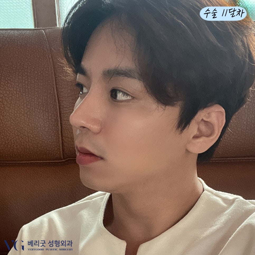 남자코 성형 다~ 모였다! 베리굿성형외과💙 관련 이미지 9