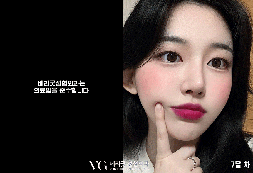 낮은 콧대 모여라❣❣ 베리굿 코끝성형으로 예뻐지자✨ 관련 이미지 3