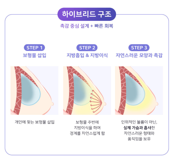 지방이식과 보형물의 장점만! 베리굿 하이브리드 가슴성형 자세히 알아보기 관련 이미지 8
