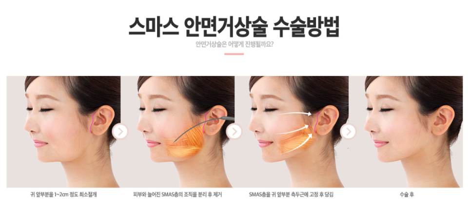 안면거상술 만으로 20년은 젊어진다?! 관련 이미지 3