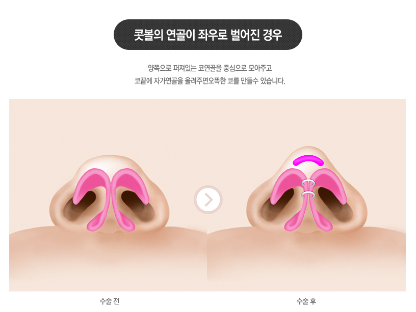 주먹코 큰코 복코!! 베리굿성형외과에서 복코 교정하자 관련 이미지 4